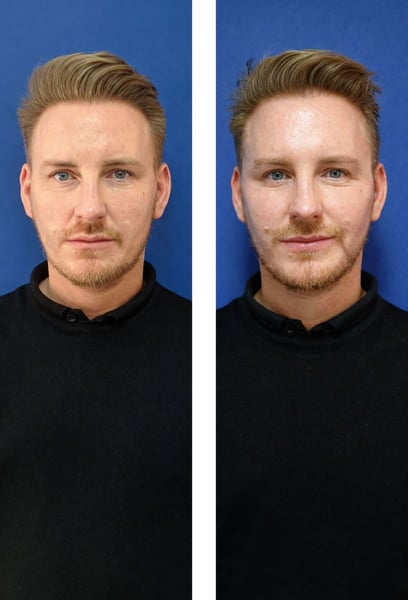 What I love about thread lifting is that it keeps getting better. A few months in, and my skin texture has improved significantly because of the collagen stimulation. My face feels firmer, tighter, and has a healthy glow. It’s like a double win: an instant lift and better skin quality.