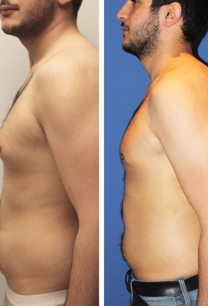 I’ve been working out for years, but no amount of chest days could fix my gynecomastia. The surgery gave me the masculine, flat chest profile I always wanted. The results look incredibly natural and finally match the rest of my fitness progress.
