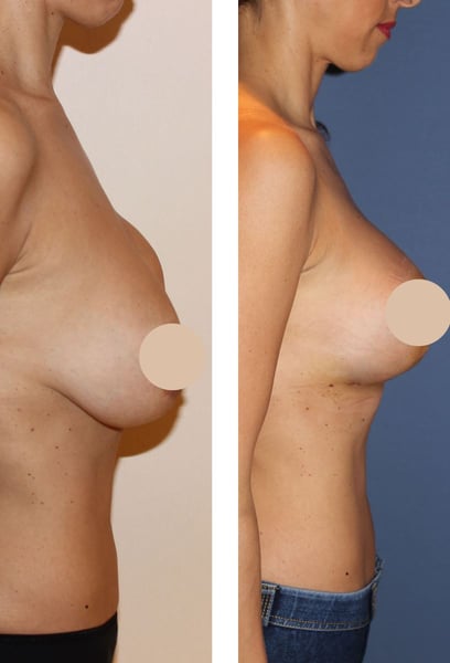 I was hesitant about the scarring, but the surgical team did an amazing job. The incisions are fading beautifully, and the shape is so natural that nobody can tell I had surgery.
