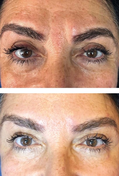I used to spend so much time trying to hide my dark circles with heavy makeup. This treatment has been a total game-changer. The hollows are filled, and the darkness has faded significantly. I finally feel confident leaving the house without a drop of concealer!