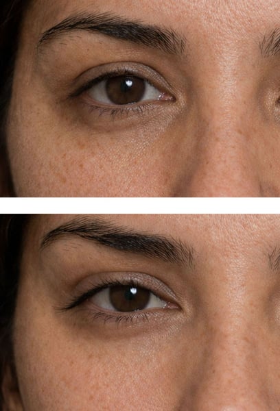 I wanted to change my eye shape but was terrified of surgery. The fox eyes treatment was like magic! In just 30 minutes, my gaze was completely transformed. The recovery was much faster than I expected, and the results are stunning.