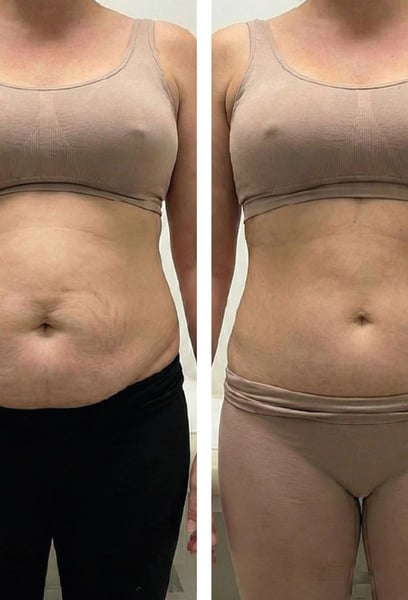 Накрая отново се чувствам като себе си след трите деца. Mommy Makeover се погрижи за всичките ми притеснения наведнъж, а резултатите надминаха очакванията ми. Възвърнах увереността си от преди бременността!