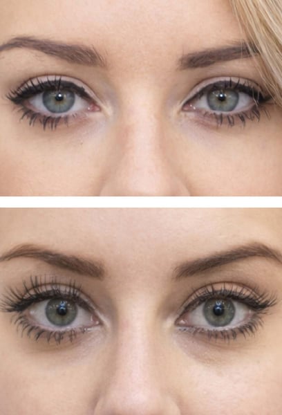 The surgery was much easier than I expected. The swelling went down quickly, and the results are amazing. My eyes look wider and more youthful without losing their character. If you’re on the fence about blepharoplasty, go for it!