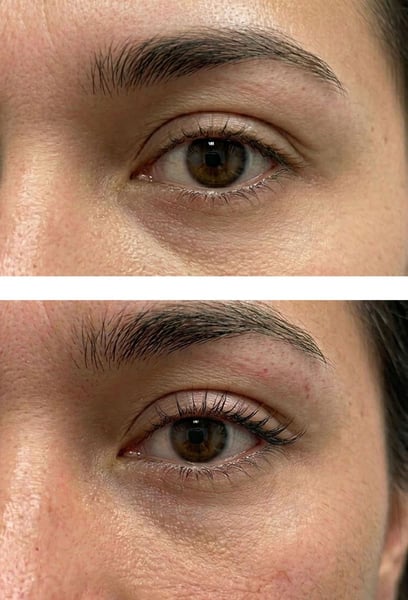 Fox Eyes is a very delicate procedure, so I was very picky about the clinic. The professionalism of the team and the detailed planning before the process made me feel so at ease. The result is perfectly symmetrical and flawless.