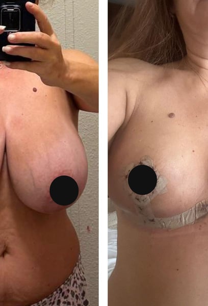 I was nervous about the procedure, but the specialists made me feel safe and informed every step of the way. Their expertise in breast reduction is world-class and the results are perfect.