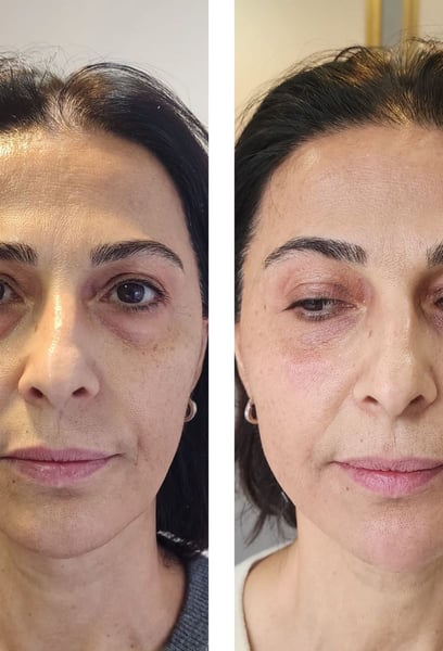 The best part was going back to work the very next day. Quick, painless, and zero downtime. My skin looks tighter and much more youthful already!