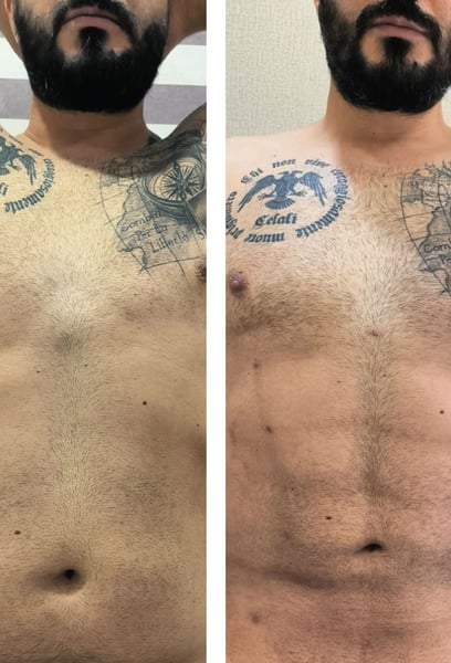 I was skeptical at first, but the outcome is mind-blowing. The symmetry and depth of my six-pack look exactly like a professional athlete's. The recovery was faster than expected, and the level of care at this hospital is world-class.