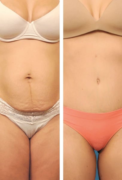 Бях притеснена да не изглеждам "прекалено", но резултатите са невероятно естествени. Силуетът ми сега е перфектно балансиран и за първи път от години се чувствам комфортно в собствената си кожа.