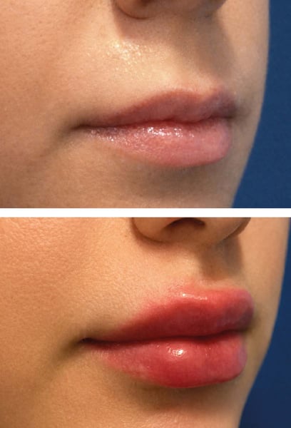 I used to overline my lips with liner and use filters to make them look fuller. Not anymore! My lips look gorgeous even without any makeup. The definition along the edges is perfect. I’m so happy with the outcome!