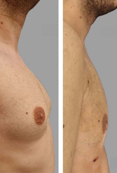 For years, I was too embarrassed to wear fitted t-shirts or even go to the beach. Since my gynecomastia surgery, my confidence has completely transformed. I can finally wear whatever I want without feeling self-conscious. I only wish I had done it sooner!