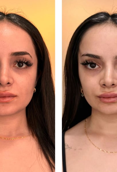 It’s been six months since my treatment, and my face still looks sculpted and toned. Unlike other temporary treatments that fade quickly, the Thread Lift has staying power. It’s given me a huge confidence boost. I highly recommend this team for anyone looking for high-quality aesthetic care.