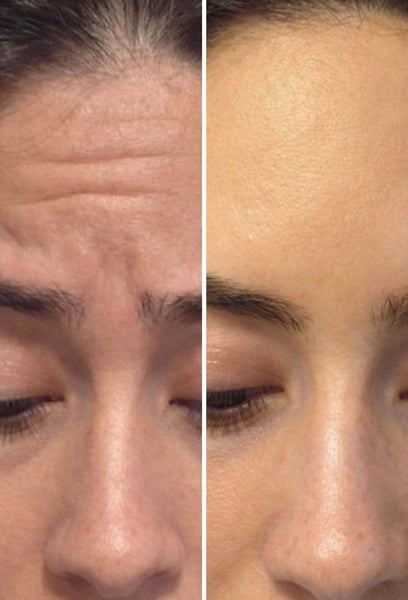 Love how subtle it looks! It smoothed out my frown lines without changing my face. It’s the perfect 'pick-me-up' for my skin. I'll definitely be back.