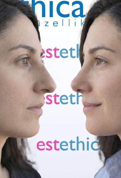 If you’re considering a hair transplant in Istanbul, this is why I chose them