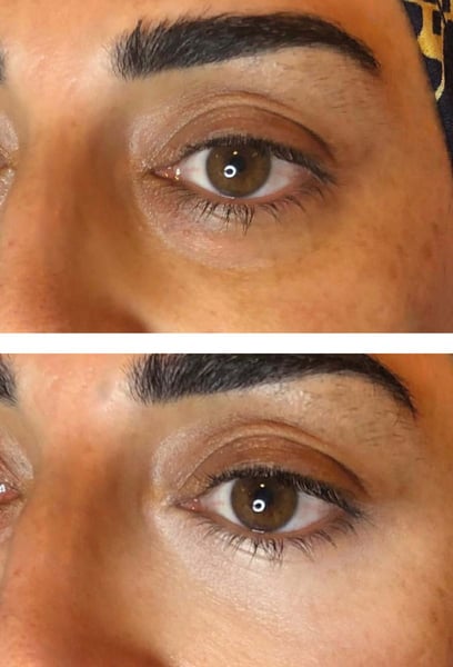 No matter how much sleep I got, I always looked exhausted. After getting the Under-Eye Light Filler, that heavy, tired look is completely gone. My eyes look bright and refreshed. It’s a subtle change that makes a massive difference. Thank you to the wonderful team!