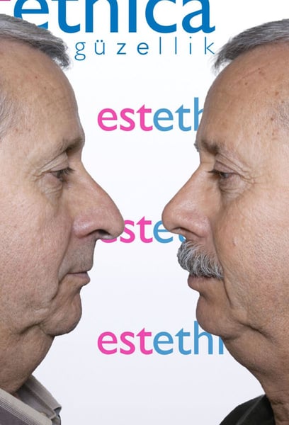 I finally found the right place for my hair transplant in Istanbul