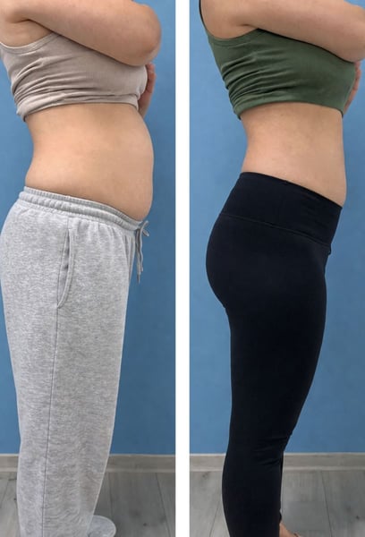 От години спазвам диета и ходя на фитнес, но никога не можех да се отърва от упоритите "любовни дръжки". След няколко сесии на регионалното отслабващо лечение тук, най-накрая виждам дефиницията, която винаги съм искал. Дрехите ми сега пасват много по-добре. Наистина работи!