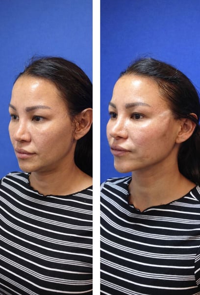 The brow thread lift opened up my gaze instantly. I look more energetic and awake. If you’re struggling with a 'heavy' forehead or tired eyes, this hospital is the place to go!