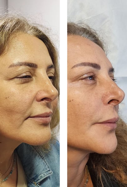 I love how natural I look! It didn’t change my face; it just made me look like a well-rested version of myself. No one can tell I had anything done.