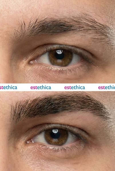 See why patients choose us for the best hair transplant in Istanbul