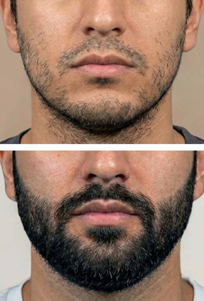 The procedure was very comfortable, and the healing process was much faster than I expected. The team was professional and explained every step clearly.
