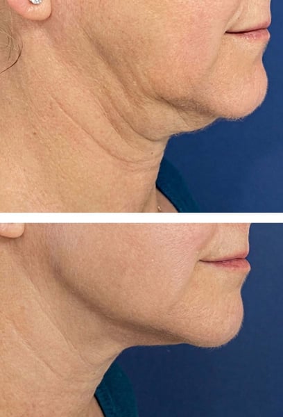 I used to hate seeing myself in side-profile photos because my chin and neck seemed to blend together. This procedure was a total game-changer. The 'double chin' is gone, and my neck looks elongated and slim. I no longer hide from the camera; I actually look forward to photos now!
