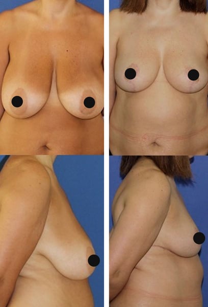 Coming to Istanbul for my breast reduction was the best decision. The care, the facility, and the final results were all exceptional. I highly recommend this clinic to anyone seeking perfection.