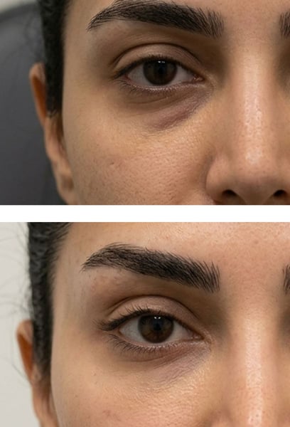 Ho sempre avuto l'impressione che i miei occhi apparissero 'pesanti' e stanchi. Dopo la procedura Fox Eyes, la forma dei miei occhi è perfettamente sollevata e inclinata proprio come desideravo. Ora ho un'espressione molto più affascinante e dinamica. Anche applicare l'eyeliner è molto più divertente!