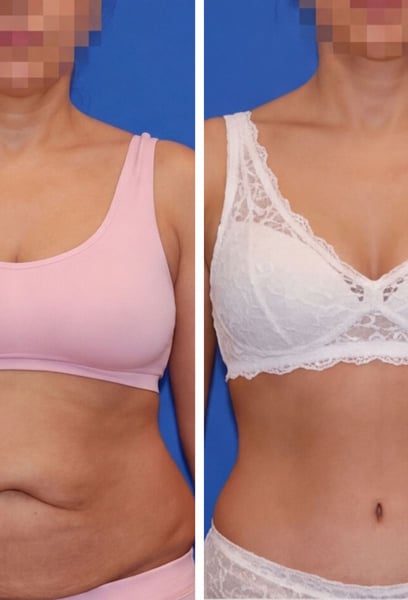 Преобразуването на коремната ми област е чудо. Свободната кожа изчезна, а мускулите ми отново се чувстват стегнати. Тази процедура ми върна тялото, което мислех, че е загубено завинаги.