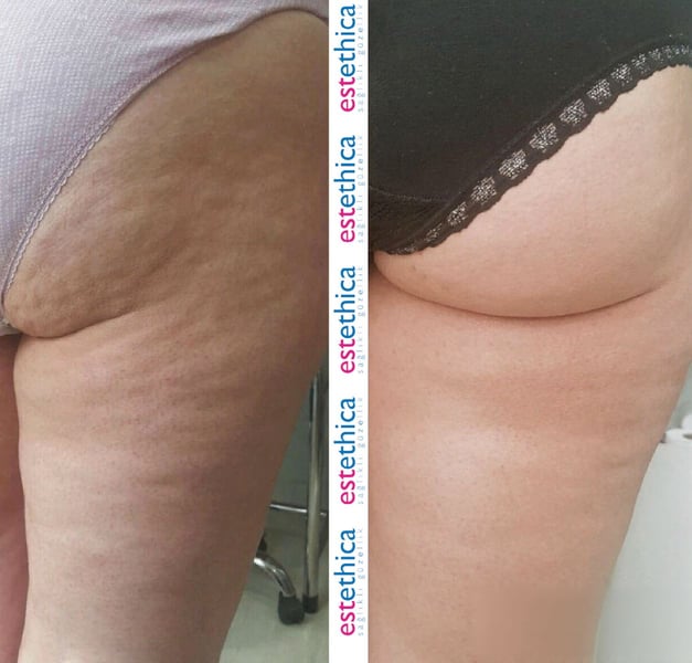 See why patients choose us for the best hair transplant in Istanbul