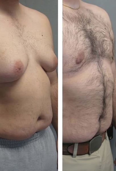 I was nervous about the procedure, but the surgeon's expertise and the team's care put me at ease. The recovery was much faster than I expected. I’ve stopped slouching to hide my chest and now I walk with my shoulders back. It’s a total game-changer.