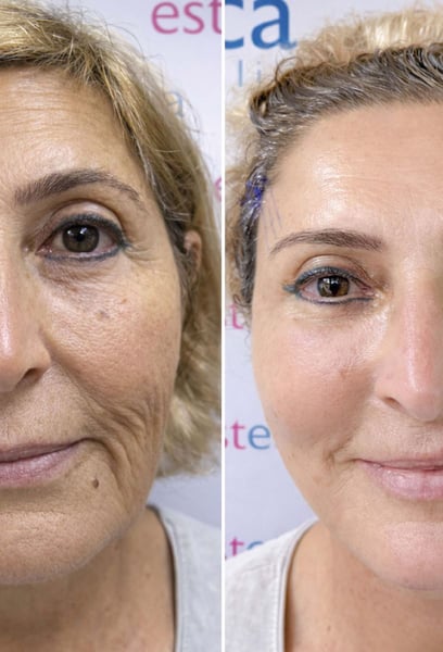 The precision of the surgery and the care during recovery were outstanding. The scars are hidden so well that they are practically invisible. Truly expert work!