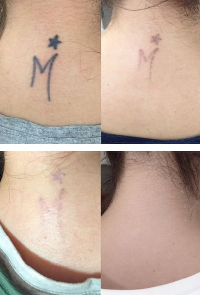 Екипът се грижи да се чувствате удобно през цялата процедура. Те обясняват следоперативната грижа толкова ясно, което ми помогна да се възстановя бързо между сесиите. Напредвам наполовина в лечението и резултатите са невероятни. Препоръчвам горещо на всеки, който иска ново начало!