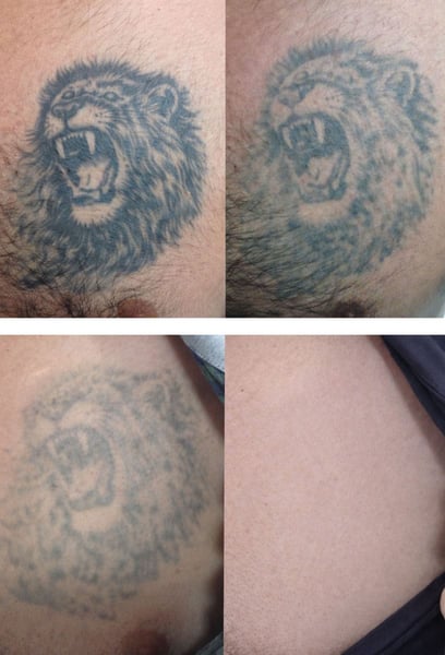 Бях скептичен относно това колко от татуировката ми може да бъде премахната, но лазерната технология, която използват, е невероятна. След само няколко сесии черната боя значително избледня, без да оставя белези. Процесът е много по-ефективен, отколкото си представях.