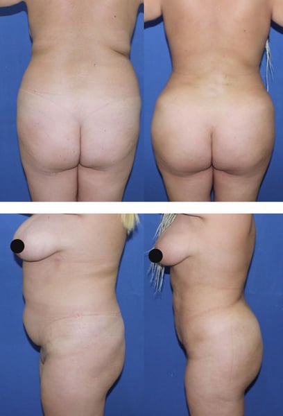 Бях много притеснен преди процедурата, но професионализмът и грижата на екипа ме успокоиха. Възстановяването ми беше много по-бързо от очакваното, а резултатът е над мечтите ми!