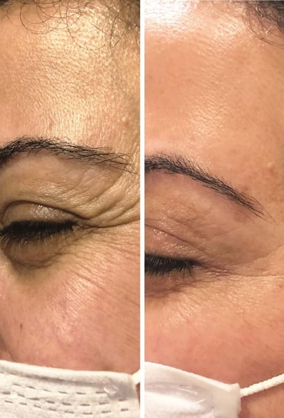 Fast treatment and amazing results. My crow's feet vanished in just a few days. The staff was professional and made me feel very comfortable. Five stars!
