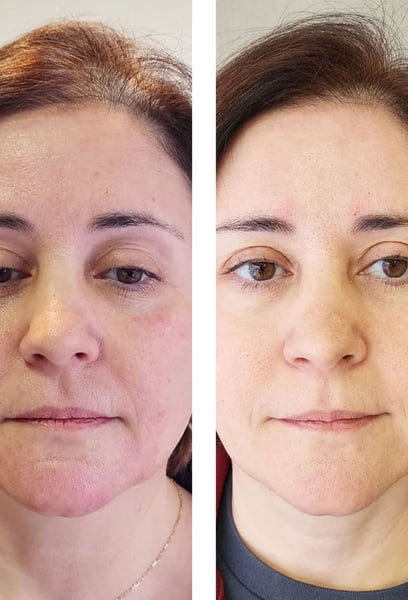 I finally look as energetic as I feel. The liquid facelift erased my hollow under-eyes and smoothed out my deep lines in under an hour. Highly recommend!