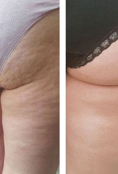 Най-голямият ми страх беше да изглеждам "изкуствено", но резултатите са толкова естествени! Никой не може да каже, че съм имала операция; просто изглеждам сякаш съм тренирала редовно. Уникална работа!