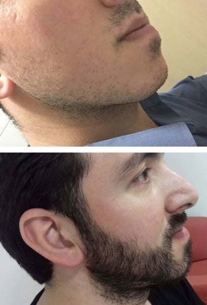 I’ve had patchy beard growth my whole life. After my transplant, I finally have the full, thick beard I’ve always wanted. The density is perfect.