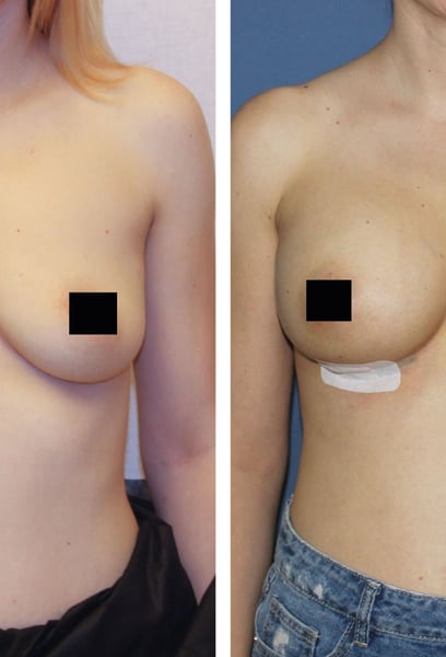 Il team è stato molto professionale. Mi hanno aiutato a scegliere la dimensione e la forma dell'impianto perfetti che si adattano perfettamente alle proporzioni del mio corpo.