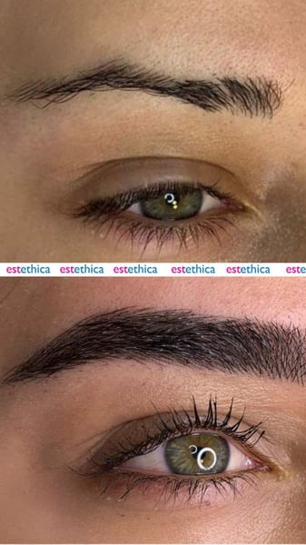 See why patients choose us for the best hair transplant in Istanbul