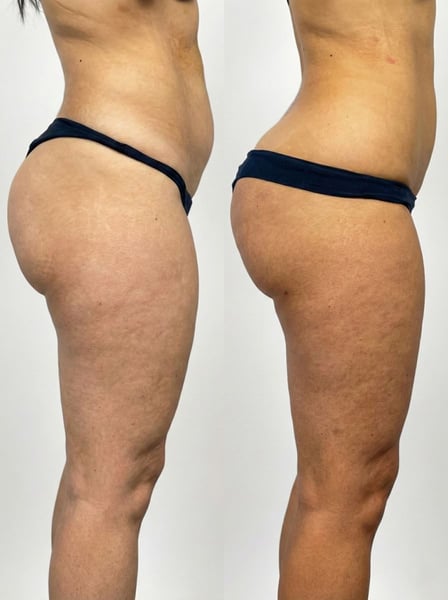 See why patients choose us for the best hair transplant in Istanbul