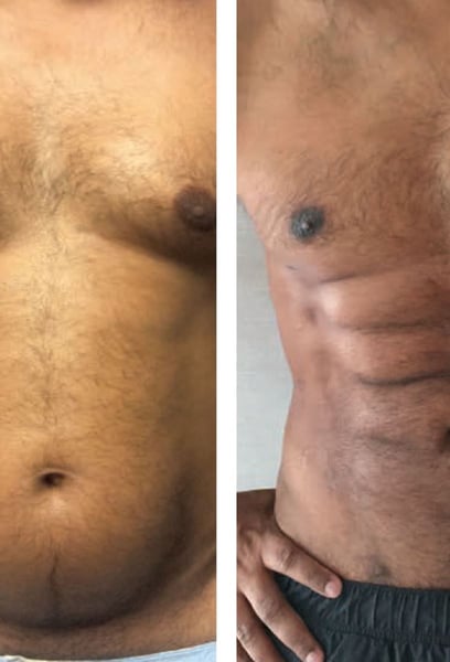 The team here doesn't just perform surgery; they create art. The way they defined my obliques and abdominal muscles is incredible. From the initial consultation to the final check-up, I felt safe and well-cared for. If you want a permanent, fit physique, this is the place.