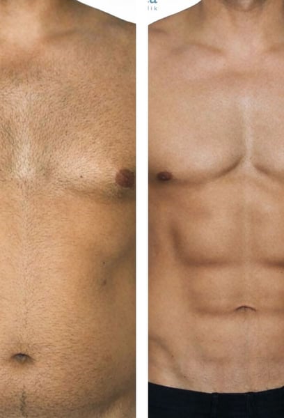 I’ve been hitting the gym for years, but I could never get my abs to pop. This procedure finally gave me that shredded, athletic look I’ve always dreamed of. The results look so natural that no one suspects a thing. The hospital staff and my surgeon were incredibly professional.