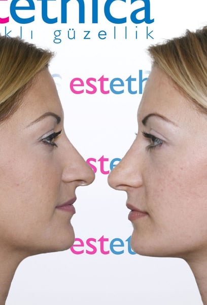 This is why I trusted them with my hair transplant in Istanbul.