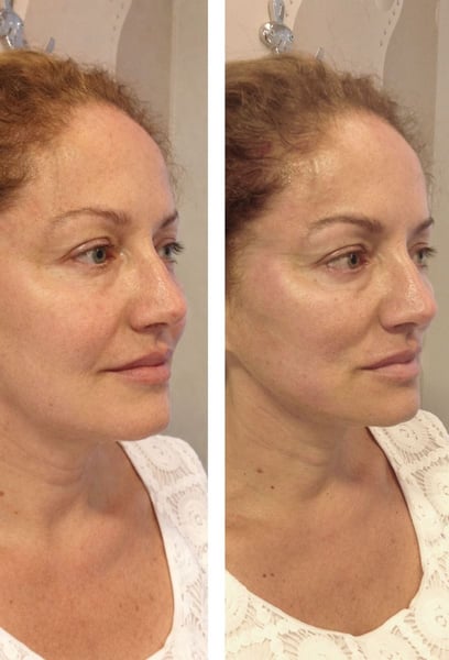 I wasn’t ready for a full surgical facelift, so I decided to try the Thread Lift. I am blown away by the results! My jawline is much more defined, and my cheekbones have a beautiful lift. It’s incredible how much younger I look without a single incision. Truly the best alternative to surgery!