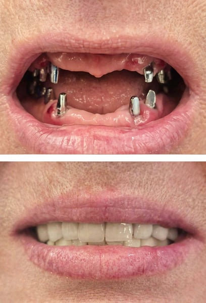 Ero titubante riguardo all'ottenere un impianto, ma il risultato è incredibile. Sembra e si sente esattamente come i miei denti naturali. Posso finalmente mangiare e sorridere di nuovo con totale fiducia!