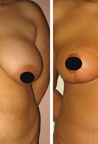 I suffered from chronic back and neck pain for years. Since my breast reduction, that weight is finally gone, and I feel incredibly light and pain-free. It’s truly a life-changing result!
