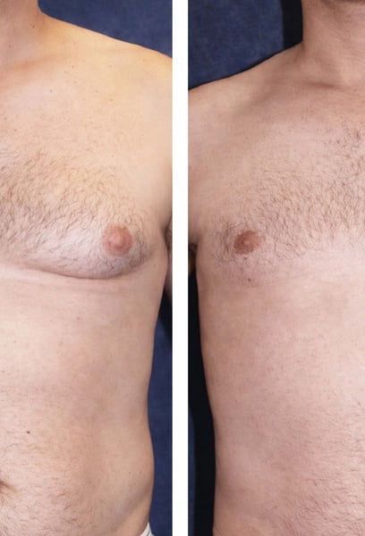 My biggest fear was visible scarring, but the technique they used left almost no trace. My chest contour is perfect, and I feel much more athletic. If you are struggling with this, don't hesitate—this clinic is top-tier.