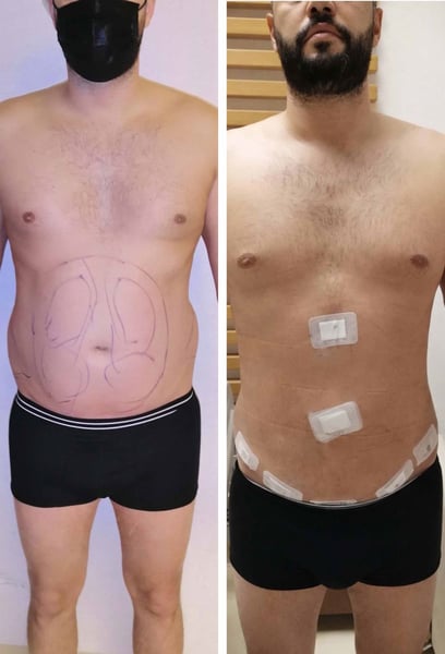 Ho frequentato la palestra per anni, ma non sono mai riuscito a far vedere i miei addominali inferiori. La liposuzione ha finalmente rimosso quell'ultimo strato di grasso ostinato che copriva i miei muscoli. La mia zona centrale ora appare tonica e atletica. Il miglior investimento in me stesso.