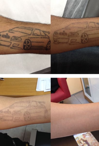 Невероятни резултати! Мислех, че старата ми татуировка никога няма да избледнее, но след последната сесия почти я няма. Прецизността и вниманието бяха на високо ниво!